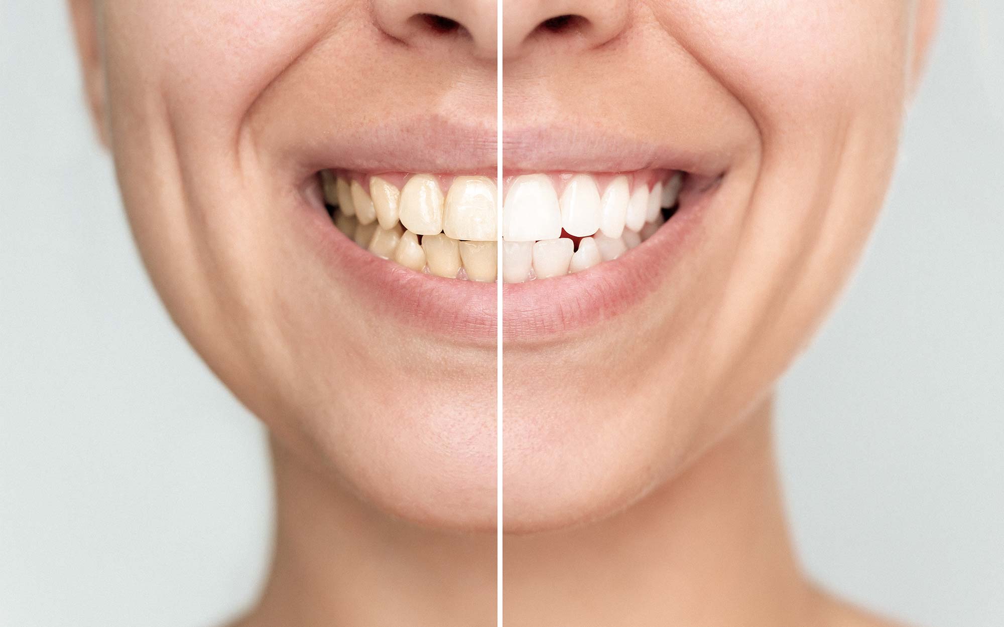 Faccette dentali