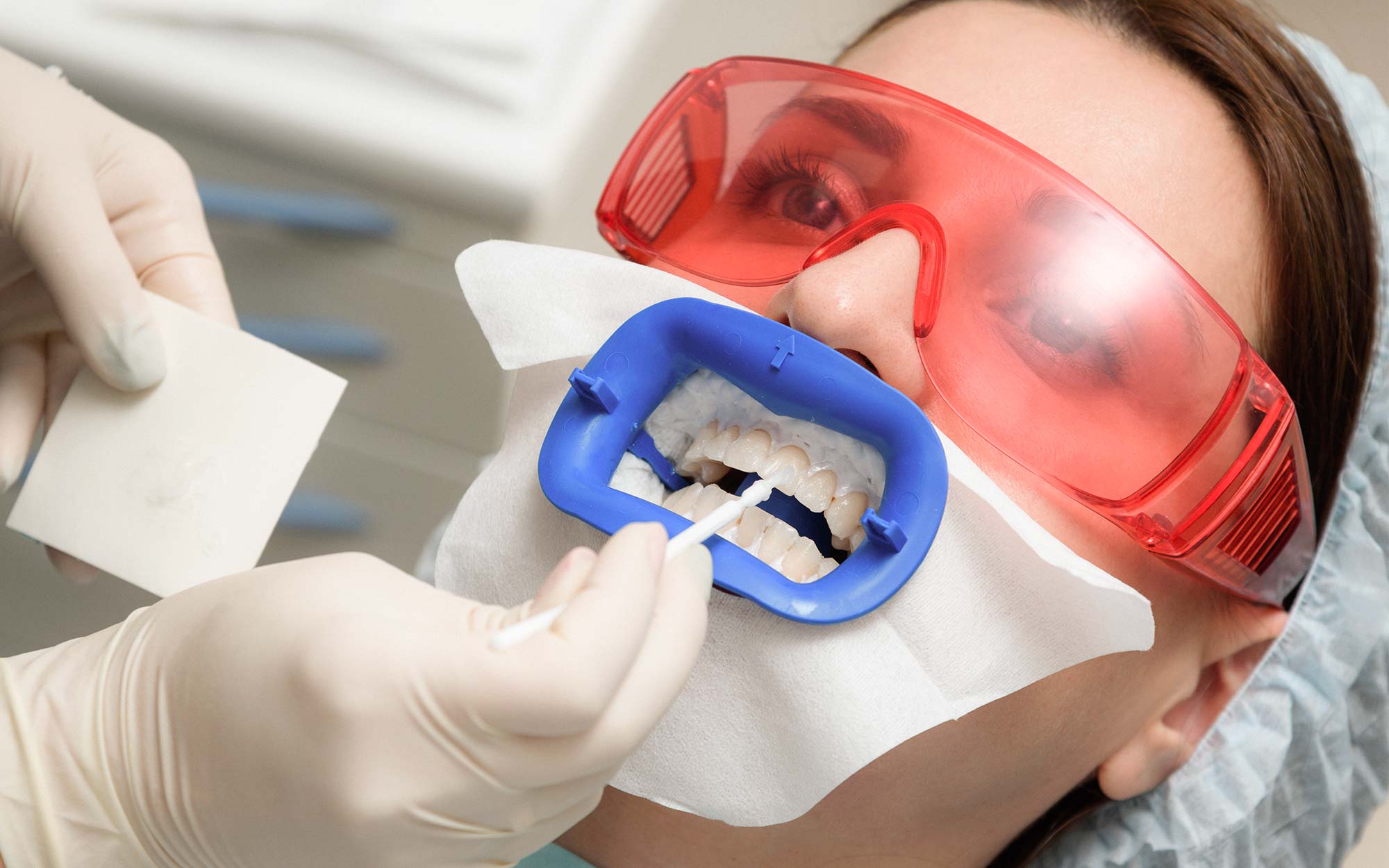 Sbiancamento dentale